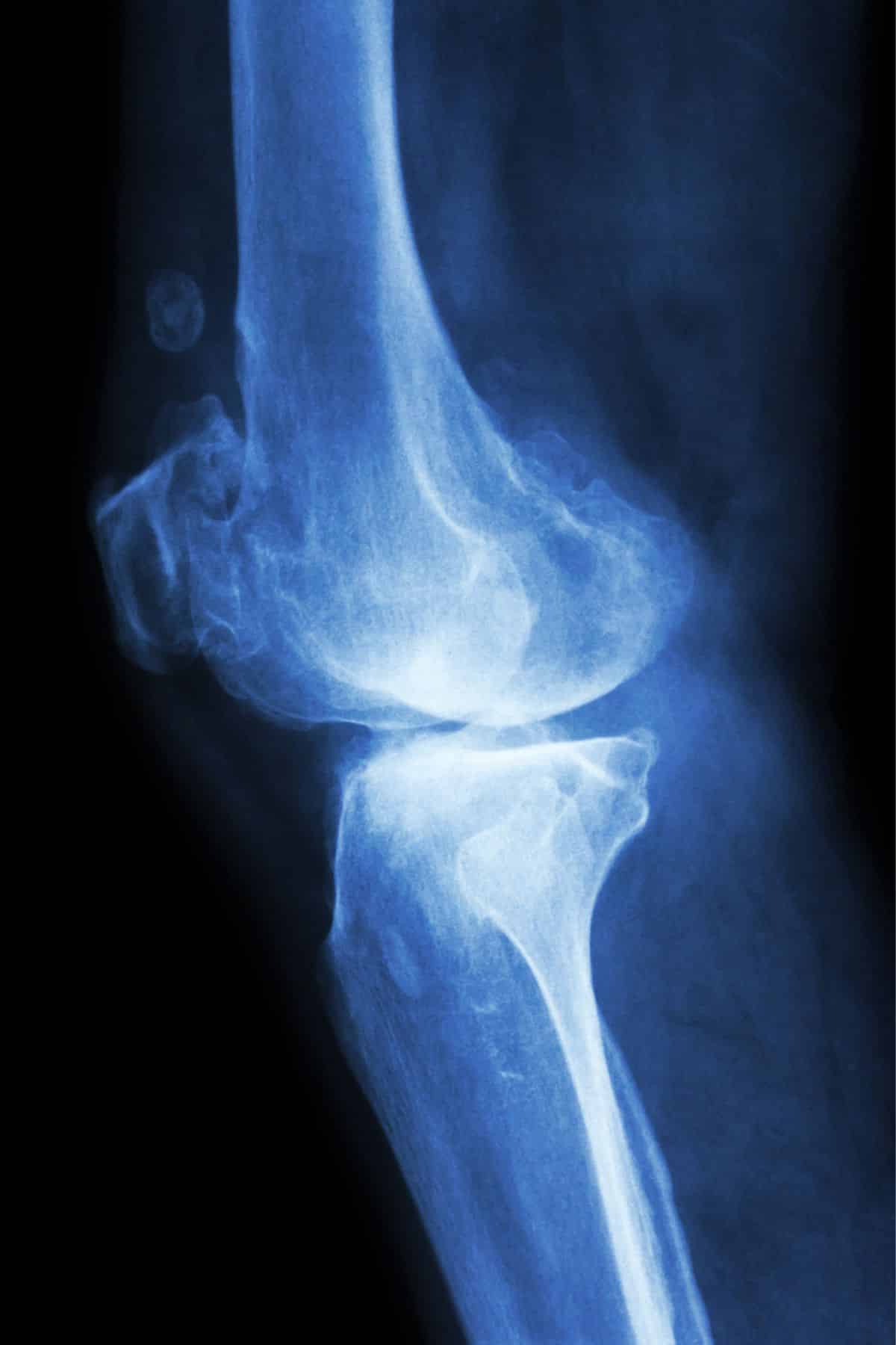 an x-ray of osteoarthritis in the knee.